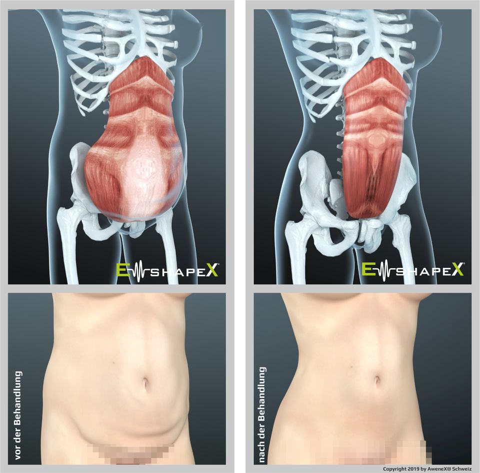 Bodyforming mit EMShapeX - EMSculpt-Alternative - Bild 4