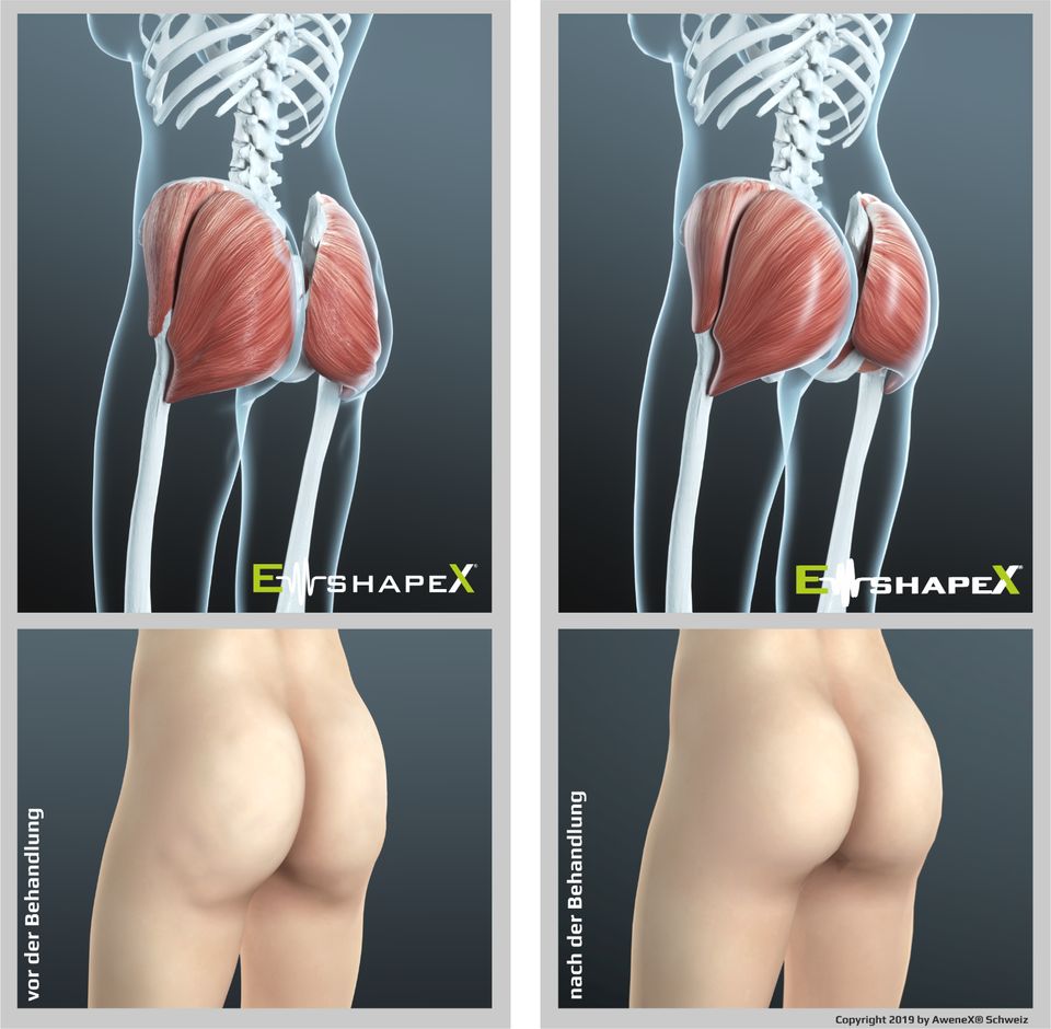 Bodyforming mit EMShapeX - EMSculpt-Alternative - Bild 5